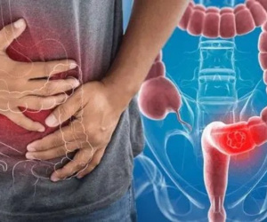 Ai dễ mắc ung thư đại trực tràng?