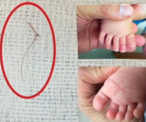 Sợi tóc thắt vào chân, bé gái 4 tháng tuổi suýt mất ngón