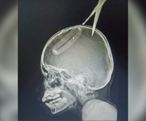 Bắt chước phim hành động, bé trai 4 tuổi ném kéo găm vào đầu chị gái