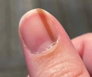 Móng tay xuất hiện sọc đen có phải ung thư da?
