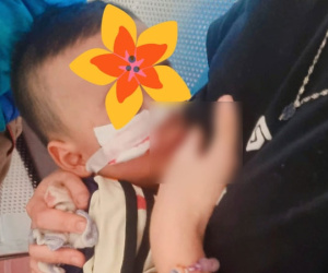 Kinh hoàng em bé 17 tháng tuổi bị trâu húc rách mặt