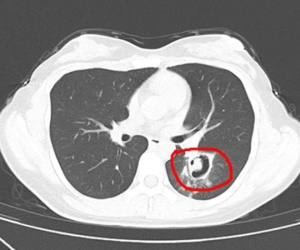 Dọn dẹp tủ quần áo, cô gái 24 tuổi mắc viêm phổi, bác sĩ nhắc 1 việc cần làm