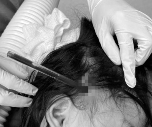 Bé gái 4 tuổi bị bút bi đâm xuyên hộp sọ