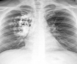 Cô gái 30 tuổi có phổi trắng bất thường như cụ già 80: Bác sĩ nói 'thủ phạm' là 1 thói quen rất hại