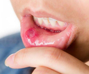 4 dấu hiệu răng miệng cảnh báo ung thư đang đến gần