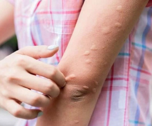 Vì sao bạn bị muỗi đốt nhiều hơn người khác? Có phải 'thịt thơm' là muỗi thích