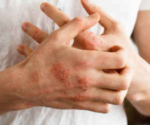 Mẩn ngứa khắp người do nắng nóng, làm gì để phòng tránh?