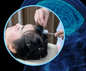 Bệnh viện gây tranh cãi khi tuyên bố: Dùng châm cứu để giúp người đến khám tăng được chỉ số IQ