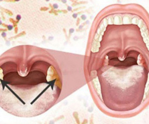 Cô gái 18 tuổi tử vong vì bệnh bạch hầu: Bệnh truyền nhiễm này nguy hiểm thế nào?
