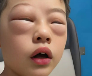 Chuyện thật như đùa: Cậu bé tiểu học 'dị ứng' với bài tập về nhà, cứ mở vở ra là mắt sưng như mắt ếch!