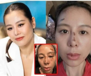 Thực hư hình ảnh Nam Thư xuất hiện với gương mặt đầy thương tích