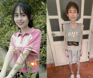 Cô gái Hưng Yên nặng 18kg sau nhiều năm không ăn cơm để giảm cân