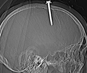 Một người ở Thanh Hóa tự đóng cây đinh dài 5 cm vào đầu mình