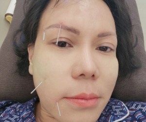 Việt Hương: 'Dây thần kinh số 7 không bị đứt mà nó co rút khiến mặt tôi biến dạng'