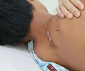 Cứu sống bé trai ngưng thở, ngưng tim 15 phút do bị sét đánh