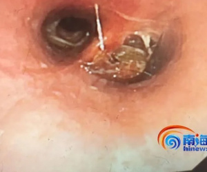 Hít phải con gián trong lúc ngủ, người đàn ông liền có thay đổi đáng sợ suốt 3 ngày sau