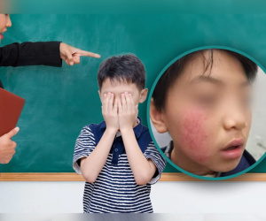 Mẹ tố con trai mất sắc tố da vì bị giáo viên liên tục tát vào mặt