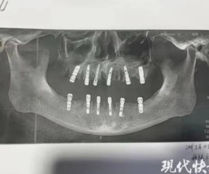 Tử vong vì nhổ và trồng gần 40 chiếc răng trong một ngày