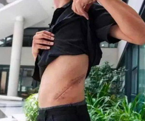 Nam thanh niên bị dụ dỗ ra nước ngoài bán thận với giá 900 triệu-1,2 tỉ đồng