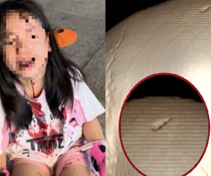 Ngồi chơi ở sân chung cư, bé gái Hà Nội bị vật cứng rơi trúng đầu, lõm sọ não nghiêm trọng