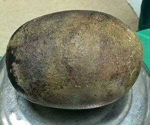 Bác sĩ ngỡ ngàng trước khối sỏi nặng tới 700g nằm trong bàng quang của nam bệnh nhân