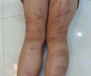 Vụ nhiều học sinh mầm non bị đánh bầm tím: Đánh các bạn là bé gái 5 tuổi