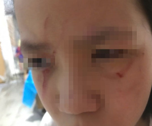 Ba giáo viên ở Hà Nội bị kỷ luật vì để nữ sinh lớp 5 bị bạn đánh rách mặt trong lớp học