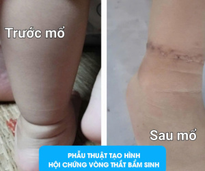 Phú Thọ: Bé gái 16 tháng tuổi có ngấn trên chân, bố mẹ tưởng bụ bẫm nhưng hoá ra lại là dị tật bẩm sinh nguy hiểm