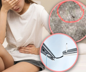 Phát hiện kim khâu vẫn còn trong 'vùng kín' sau 18 năm chịu những cơn đau hành hạ