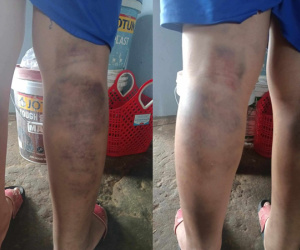 Tạm đình chỉ giáo viên đánh học sinh bầm tím 2 chân
