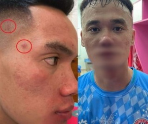 Vụ ẩu đả gây tranh cãi làng bóng Việt: Cầu thủ đấm Xuân Nam hé lộ ảnh thương tích, tố bị đập giày vào đầu