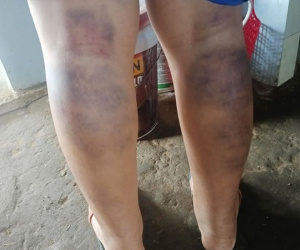 Cô giáo đánh nam sinh bầm tím 2 chân bị kỷ luật cảnh cáo