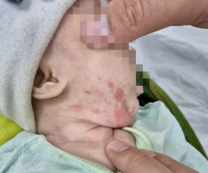 Bé gái 2 tháng tuổi mắc giang mai, bố mẹ đều bất ngờ