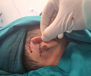Bé trai 8 tuổi ở Hà Nội bị chó nhà cắn gần đứt rời vành tai