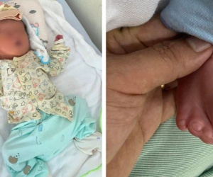 Bố mẹ bàng hoàng khi con chào đời dị tật nghiêm trọng dù siêu âm 8 lần không phát hiện bất thường