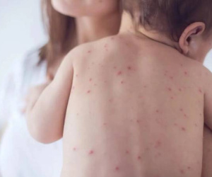 Bé gái 8 tháng tuổi ở Bình Dương tử vong do bệnh sởi