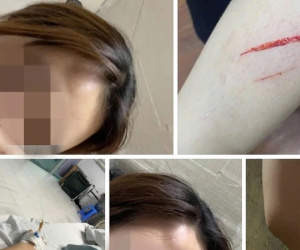 Tình hình sức khoẻ hiện tại của nữ sinh bị đánh nhập viện vì mâu thuẫn 'tiền tip' ở Hà Nội