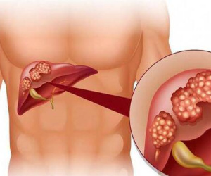 'Thủ phạm mới' vượt viêm gan virus, trở thành nguyên nhân hàng đầu gây ung thư gan tại Việt Nam