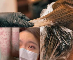 Nữ sinh 20 tuổi trả giá đắt vì đam mê nhuộm tóc: Thận xuất huyết, phải cạo trọc đầu giữ mạng