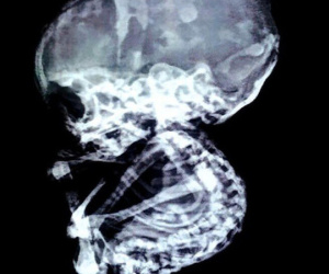 15 năm sau khi nạo thai, sốc vì bào thai vẫn còn nguyên trong bụng mẹ, hóa đá