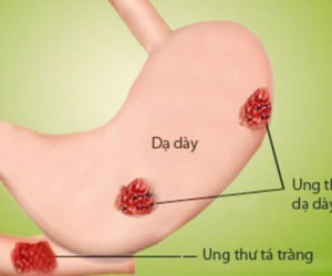 Tại sao ung thư đã chữa khỏi lại tái phát?