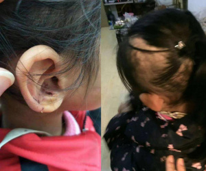 Bé gái 6 tuổi bị mẹ đẻ ngược đãi dã man khiến mặt đầy vết thương, tóc rụng thành mảng lớn