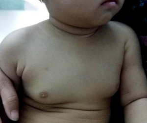 Bé gái 2 tuổi ngực phì đại do thuốc tránh thai từ mẹ