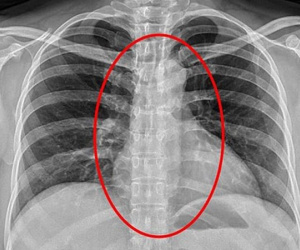 Gái bán dâm nuốt... bao cao su của khách để giấu bằng chứng khi bị cảnh sát bắt