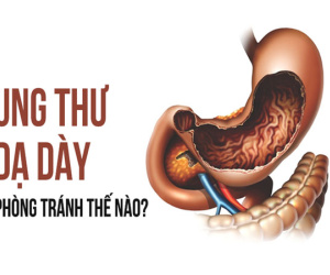 Tất cả về ung thư dạ dày: Biết để tránh xa căn bệnh nguy hiểm, dễ tái phát