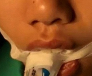 Bé gái suýt chết sau khi được mẹ nặn mụn đầu đen