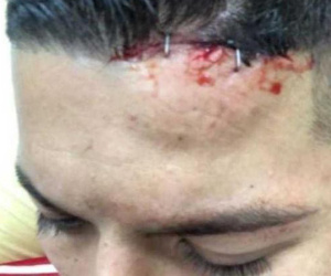 Rojo 'khoe' chấn thương ghê rợn sau trận gặp Man City