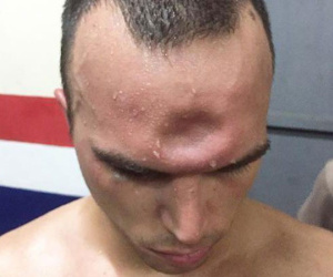 SỐC: Võ sĩ Muay Thái lõm trán kinh hoàng sau cú thúc chỏ của đối thủ