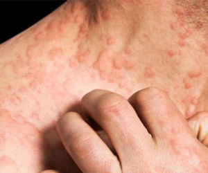 Gan có thể đang kêu cứu nếu cơ thể xuất hiện các dấu hiệu này