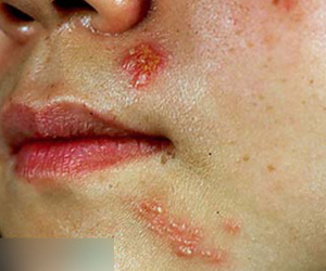 Mụn rộp sinh dục, chớ xem thường